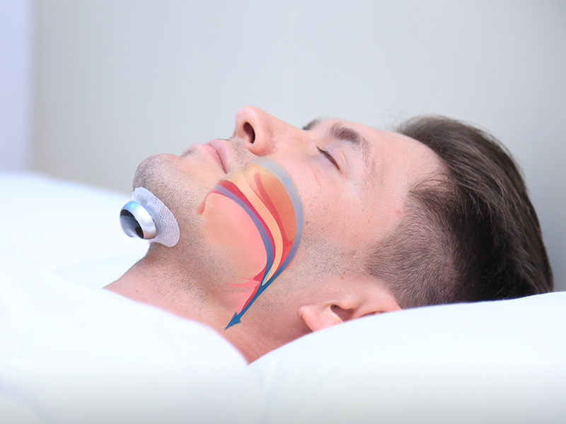 Dispositivo antirronquidos SnoozeFix: mejore su sueño con tecnología cómoda