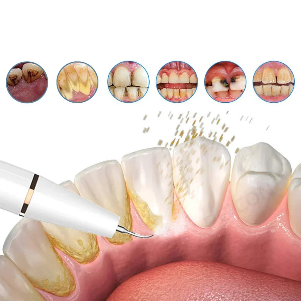 Cepillo de dientes ultrasónico FreshSmile: para unos dientes limpios y sanos