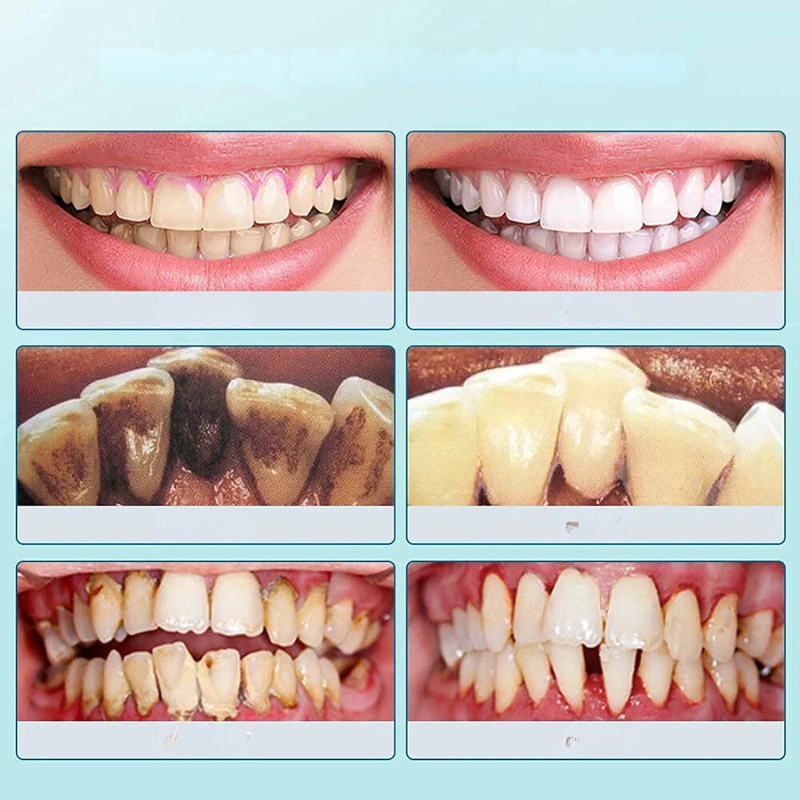 Cepillo de dientes ultrasónico FreshSmile: para unos dientes limpios y sanos